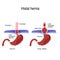 Hiatal hernia. Vector diagram of Normal anatomy and sliding hiatal hernia
