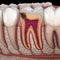 Hidden caries in to molar tooth. Medically accurate 3D illustration