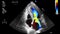 High quality transesophageal ultrasound video in Doppler mode.