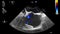 High-quality video ultrasound transesophageal examination of the heart.