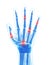 Highlighted arthritic hand