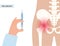 Hip joint injection