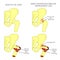 Hip joint problem_Mixed femoroacetabular impingement