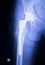 Hip joint replacement xray