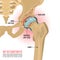 Hip Osteoarthritis Infographic