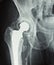 Hip prosthesis implant, hip replacement