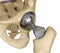 Hip replacement implant installed in the pelvis bone