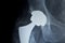 Hip replacement implant Xray scan