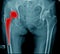 Hip replacement x-ray image