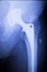 Hip replacement xray orthopedic medical scan