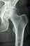 Hip xray, classic radiography