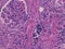 Histology of abnormal tissue (calcium)