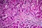 Histopathology of biliary cirrhosis