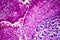 Histopathology of biliary cirrhosis