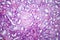 Histopathology of hypertensive renal disease, light micrograph