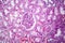 Histopathology of hypertensive renal disease, light micrograph