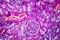 Histopathology of hypertensive renal disease, light micrograph