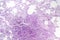 Histopathology of interstitial pneumonia