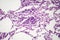 Histopathology of interstitial pneumonia