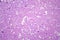 Histopathology of Japanese encephalitis, light micrograph