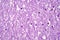 Histopathology of Japanese encephalitis, light micrograph