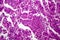 Histopathology of lung cancer