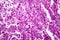 Histopathology of lung cancer