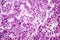 Histopathology of lung cancer