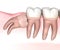 Horizontal impaction of Wisdom tooth. Medically accurate tooth 3D illustration