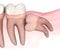 Horizontal impaction of Wisdom tooth. Medically accurate tooth 3D illustration