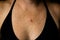 Horizontal view of basal cell carcinoma on young 30s caucasian female chest