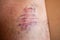 Huge bruise on the body. Close-up - wounded leg with bruise and abrasion. Injured skin. Household injuries, harm to health