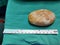 Huge laminated stone in Urinary Bladder extracted via Open Vesicolithotomy