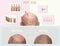 Human alopecia or hair loss - adult man hand holding comb