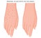 Human body problem_Removal of age spots on the hands 1