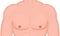 Human body problem_stretch marks on European man breast and shoulders