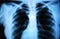 Human body\'s radiograph - lung