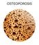 Human bone disease- osteoporosis