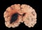 Human brain. Hemorrhagic infarct