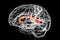 Human brain with highlighted Corpus callosum