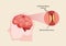 Human brain stroke illustration