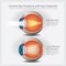 Human Eye Anatomy and Normal Lens