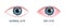 Human eye healthy and dry. Normal and inflamed bloodshot eyeball with irritation and red conjunctiva. Symptoms of