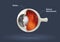 Human eye - retinal detachment