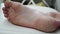 Human foot. Dry skin, Psoriasis of the feet. The skin is damaged. Dermatitis, eczema, psoriasis, allergic reaction.