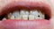 Human front teeth and lips close-up. Natural tooth color.