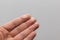 Human hand with painful blisters on three fingertips from touching hot pan isolated on white background