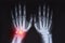 Human hands x ray highlighted in red