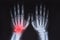 Human hands x ray highlighted in red