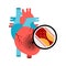 Human heart anatomy with heart attack. Atherosclerotic plaque in the blood vessels.